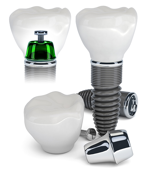 dental implants in south milwaukee