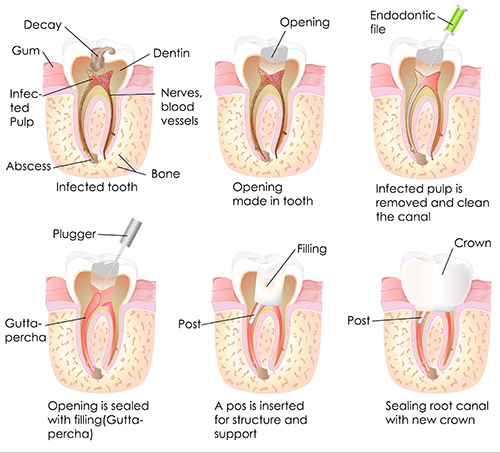 root canal treatment in south milwaukee