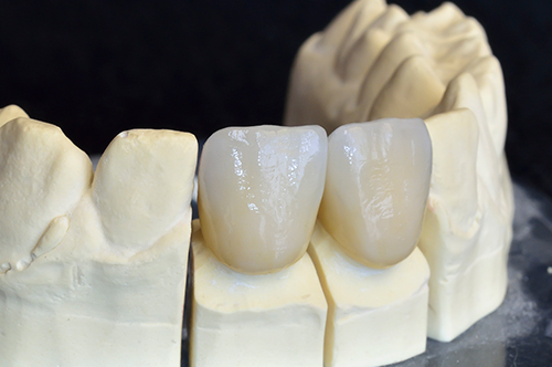 ceramic crowns in south milwaukee